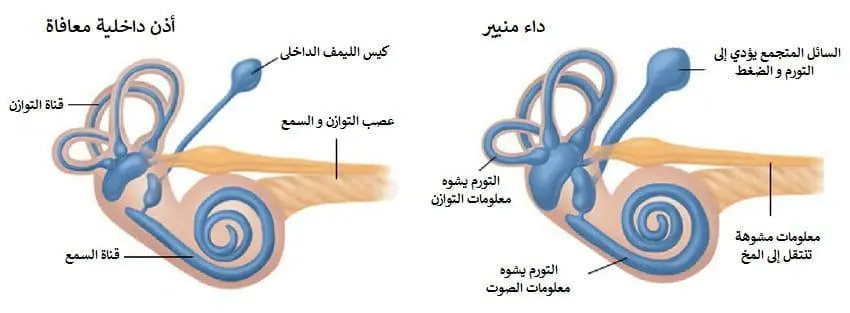 داء منيير