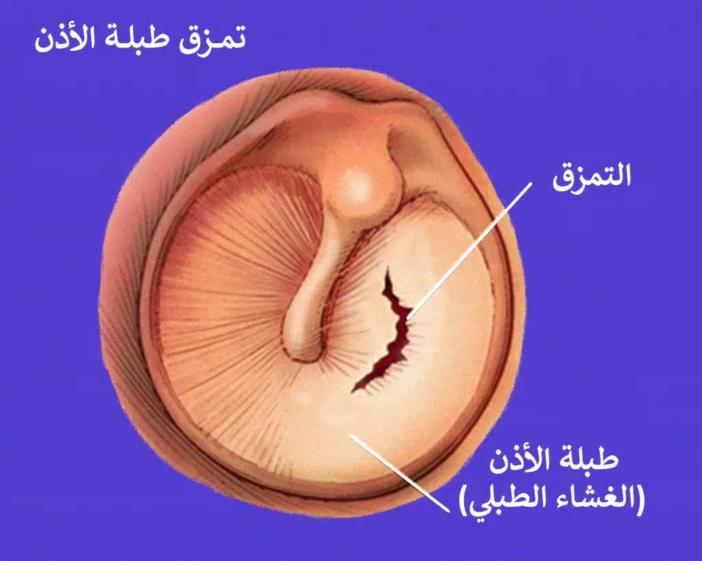 تمزق طبلة الأذن