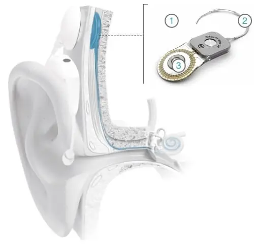 ab hires ultra 3d composants