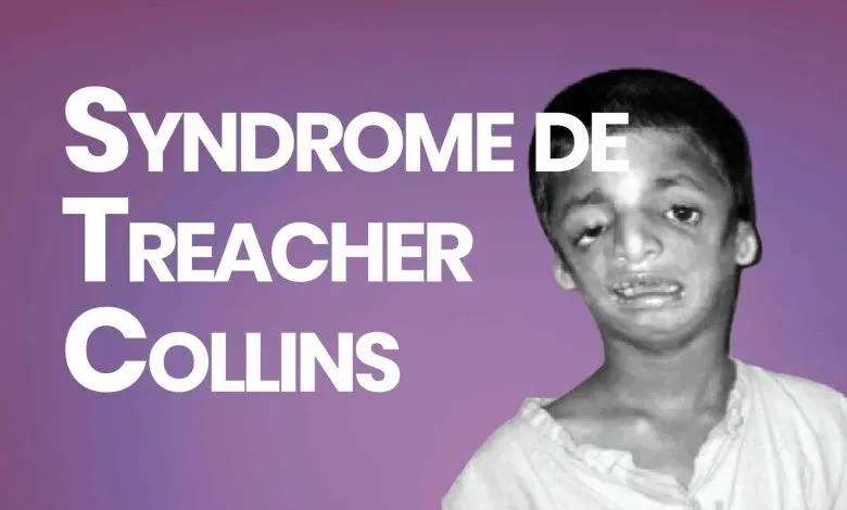 syndrome de treacher collins