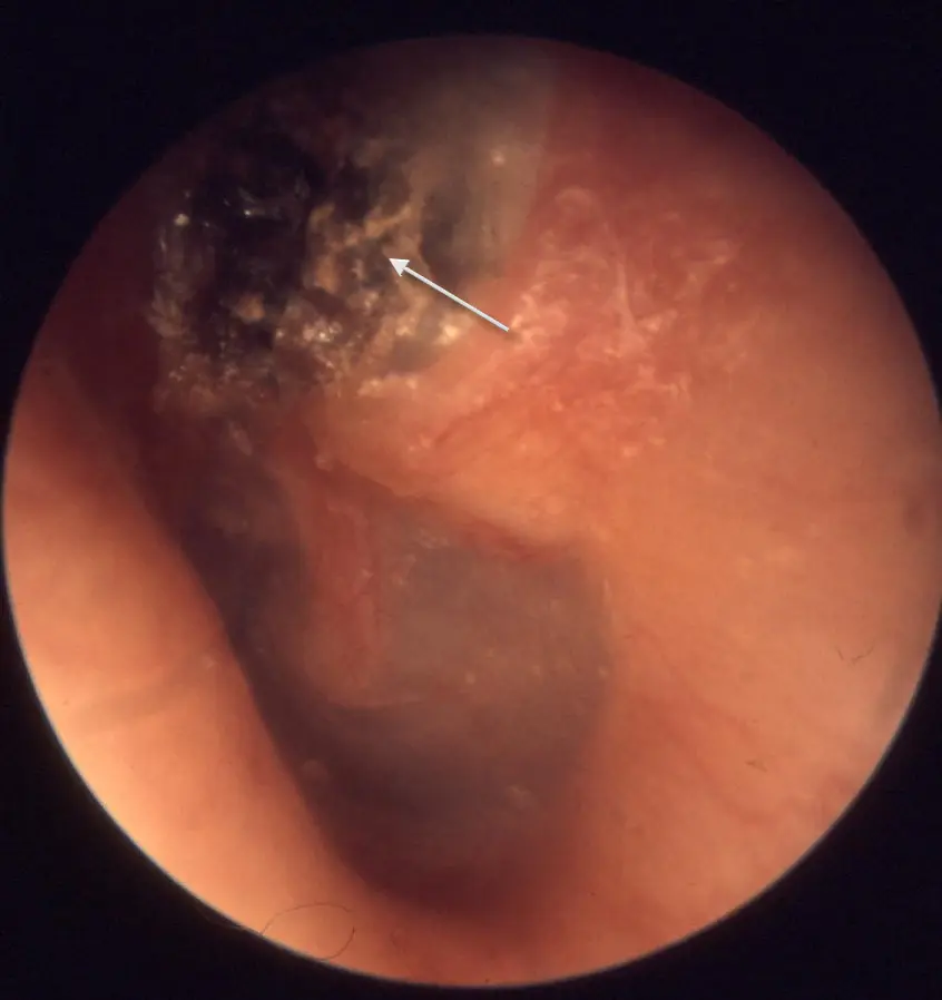 Image médicale de l'intérieur de l'oreille humaine.