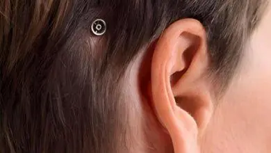 Implant auditif derrière une oreille humaine