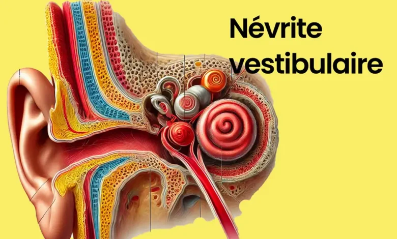 Illustration de l'oreille avec névrite vestibulaire