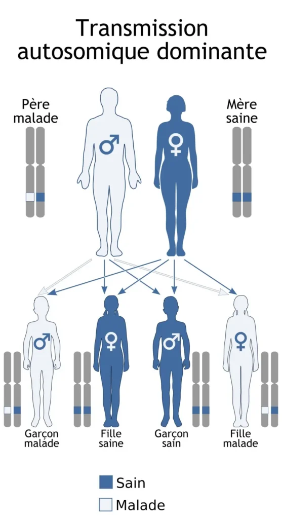 Schéma de transmission génétique autosomique dominante.